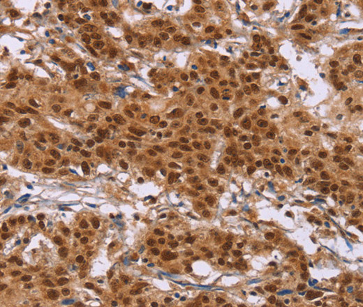 Immunohistochemistry of paraffin-embedded Human gastric cancer tissue using CTNNBL1 Polyclonal Antibody at dilution 1:50