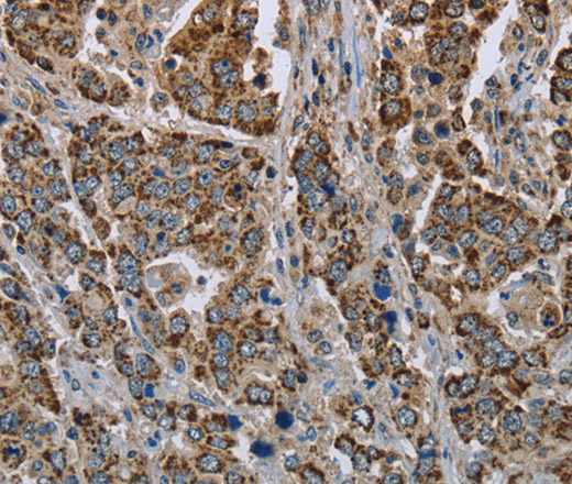 Immunohistochemistry of paraffin-embedded Human liver cancer using GOT2 Polyclonal Antibody at dilution of 1:50