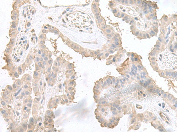 Immunohistochemistry of paraffin-embedded Human thyroid cancer tissue  using STAU2 Polyclonal Antibody at dilution of 1:45(?200)