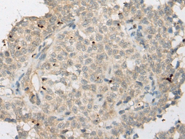 Immunohistochemistry of paraffin-embedded Human ovarian cancer tissue  using ZNF449 Polyclonal Antibody at dilution of 1:50(?200)