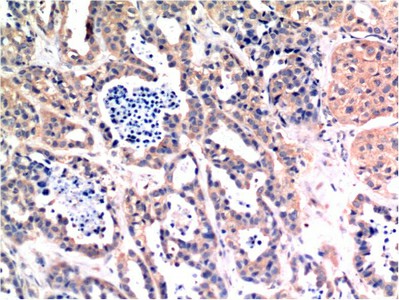 Immunohistochemistry of paraffin-embedded Human breast carcinoma  tissue using Bax Monoclonal Antibody at dilution of 1:200.