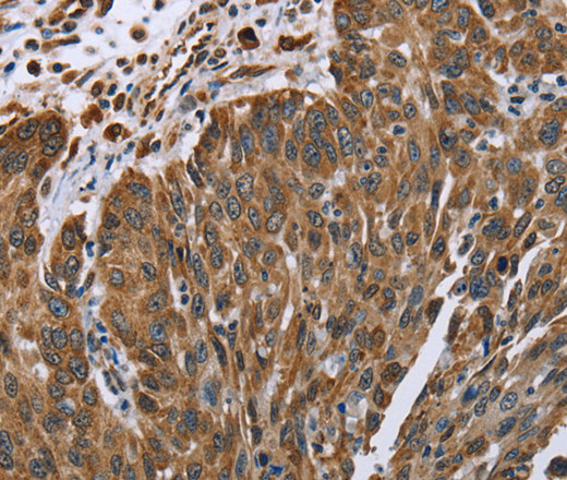 Immunohistochemistry of paraffin-embedded Human lung cancer tissue using PLXNB1 Polyclonal Antibody at dilution 1:40