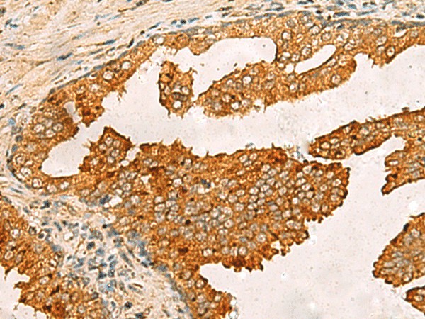 Immunohistochemistry of paraffin-embedded Human prost at e cancer tissue  using BECN1 Polyclonal Antibody at dilution of 1:30(?200)