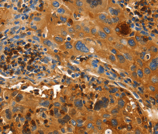 Immunohistochemistry of paraffin-embedded Human lung cancer using ORM2 Polyclonal Antibody at dilution of 1:50