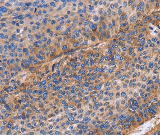 Immunohistochemistry of paraffin-embedded Human liver cancer using ITGB1 Polyclonal Antibody at dilution of 1:60