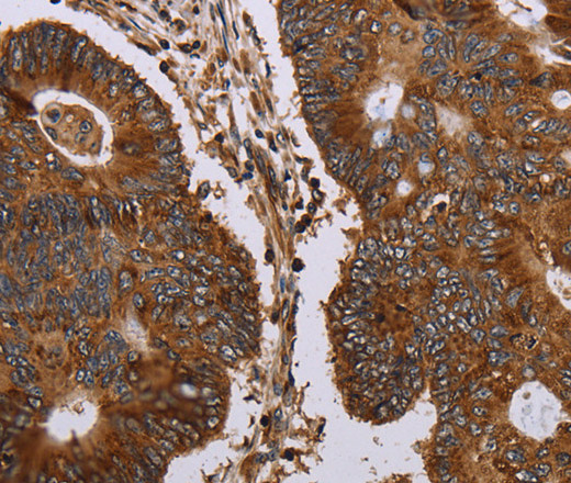 Immunohistochemistry of paraffin-embedded Human colon cancer tissue using MAGEC2 Polyclonal Antibody at dilution 1:40