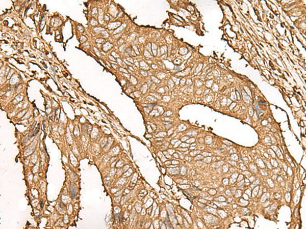 Immunohistochemistry of paraffin-embedded Human colorectal cancer tissue  using UBE2A Polyclonal Antibody at dilution of 1:45(?200)