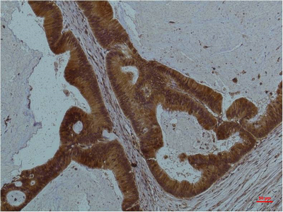 Immunohistochemistry of paraffin-embedded Human colon carcinoma tissue using STAT3 Monoclonal Antibody at dilution of 1:200.