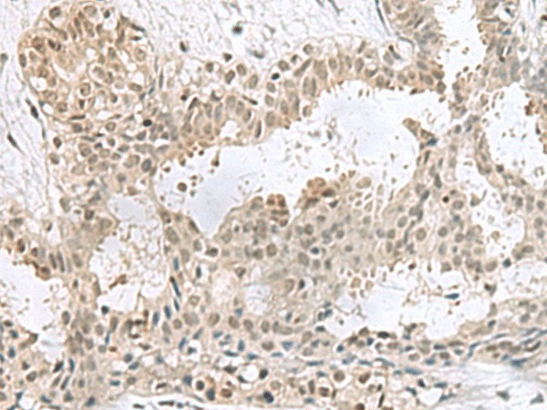 Immunohistochemistry of paraffin-embedded Human breast cancer tissue  using PCBD1 Polyclonal Antibody at dilution of 1:60(?200)