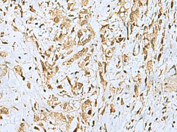 Immunohistochemistry of paraffin-embedded Human gastric cancer tissue  using HOXC9 Polyclonal Antibody at dilution of 1:110(?200)