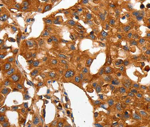 Immunohistochemistry of paraffin-embedded Human lung cancer using CAP2 Polyclonal Antibody at dilution of 1:50