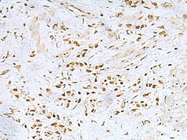 Immunohistochemistry of paraffin-embedded Human gastric cancer tissue  using FOXQ1 Polyclonal Antibody at dilution of 1:25(?200)