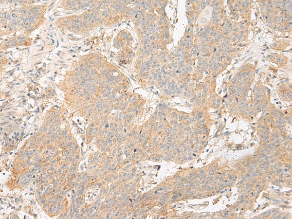 Immunohistochemistry of paraffin-embedded Human esophagus cancer tissue  using GP6 Polyclonal Antibody at dilution of 1:40(?200)