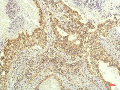 Immunohistochemistry of paraffin-embedded Human lung carcinoma tissue using p70 S6 kinase alpha Monoclonal Antibody at dilution of 1:200.