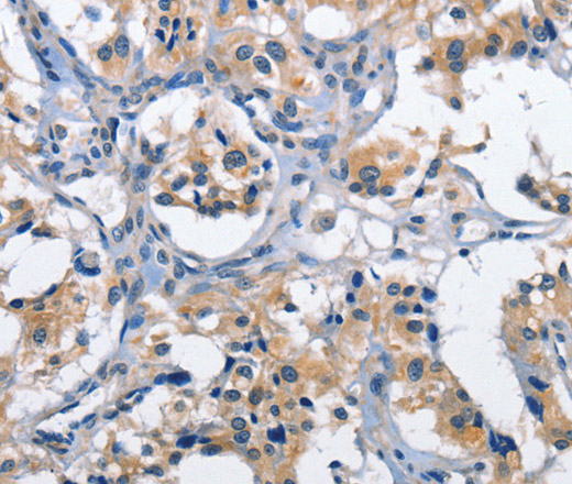 Immunohistochemistry of paraffin-embedded Human thyroid cancer tissue using CLEC2D Polyclonal Antibody at dilution 1:60