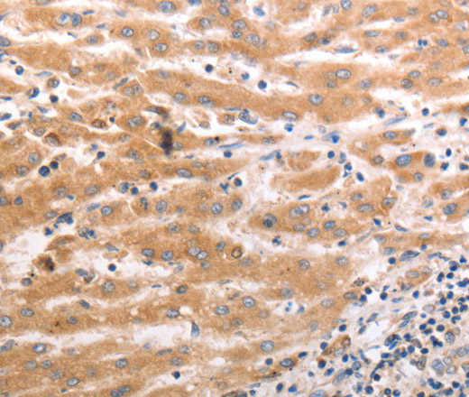 Immunohistochemistry of paraffin-embedded Human liver cancer tissue using HCRTR1 Polyclonal Antibody at dilution 1:70