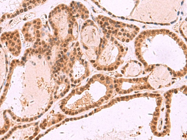 Immunohistochemistry of paraffin-embedded Human thyroid cancer tissue  using MCMBP Polyclonal Antibody at dilution of 1:35(?200)