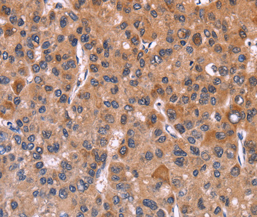 Immunohistochemistry of paraffin-embedded Human liver cancer tissue using FBXW7 Polyclonal Antibody at dilution 1:30