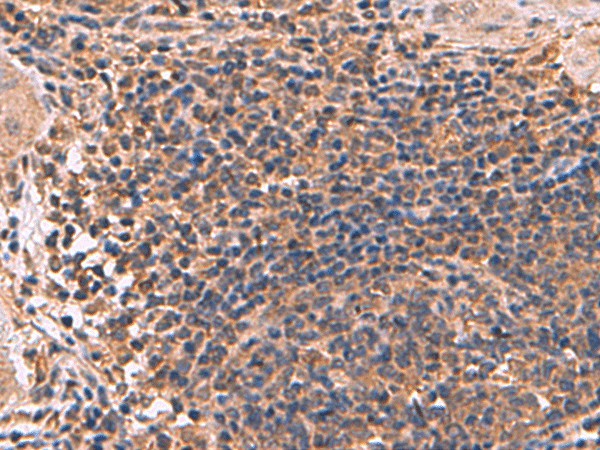 Immunohistochemistry of paraffin-embedded Human cervical cancer tissue  using ZBTB33 Polyclonal Antibody at dilution of 1:30(?200)