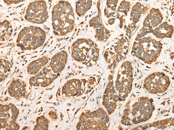 Immunohistochemistry of paraffin-embedded Human esophagus cancer tissue  using BAIAP2L1 Polyclonal Antibody at dilution of 1:30(?200)