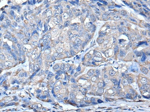 Immunohistochemistry of paraffin-embedded Human breast cancer tissue  using PRKAR2A Polyclonal Antibody at dilution of 1:50(?200)