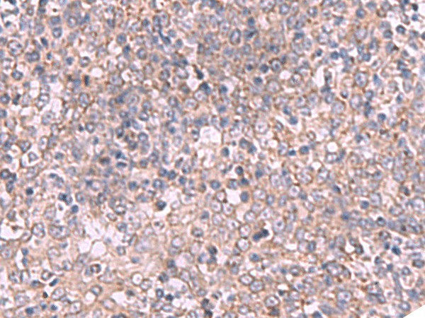 Immunohistochemistry of paraffin-embedded Human tonsil tissue  using ECSIT Polyclonal Antibody at dilution of 1:70(?200)