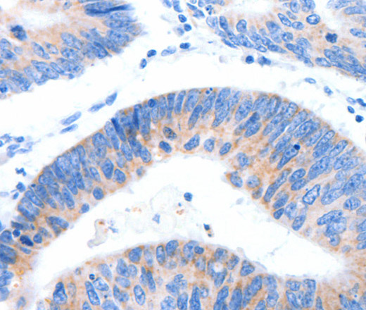 Immunohistochemistry of paraffin-embedded Human colon cancer tissue using MUC3A Polyclonal Antibody at dilution 1:60