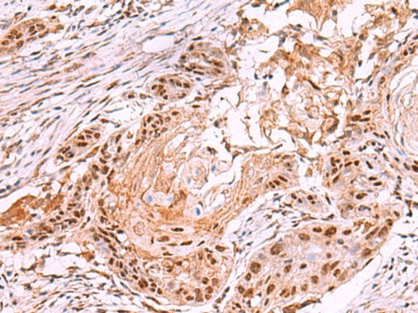 Immunohistochemistry of paraffin-embedded Human esophagus cancer tissue  using IRX4 Polyclonal Antibody at dilution of 1:35(?200)