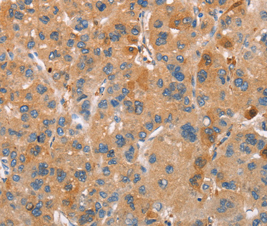 Immunohistochemistry of paraffin-embedded Human liver cancer using PLIN2 Polyclonal Antibody at dilution of 1:30