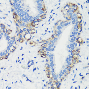 Immunohistochemistry of paraffin-embedded Human breast cancer using FLNA Polyclonal Antibody at dilution of 1:100 (40x lens).