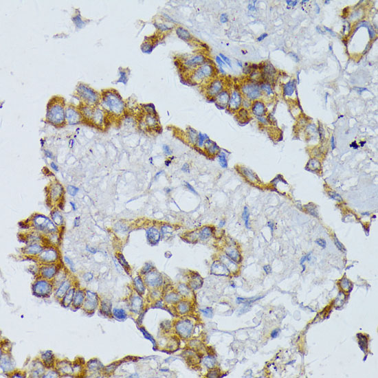 Immunohistochemistry of paraffin-embedded human lung cancer using ACADL Polyclonal antibody at dilution of 1:100 (40x lens).Perform microwave antigen retrieval with 10 mM PBS buffer pH 7.2 before commencing with IHC staining protocol.