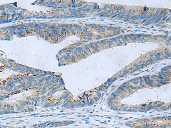 Immunohistochemistry of paraffin-embedded Human colorectal cancer tissue  using GLS Polyclonal Antibody at dilution of 1:60(?200)