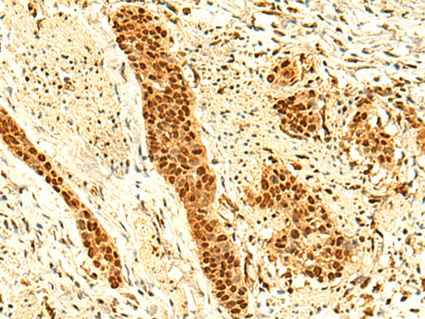 Immunohistochemistry of paraffin-embedded Human esophagus cancer tissue  using UNKL Polyclonal Antibody at dilution of 1:50(?200)