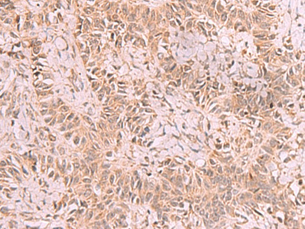 Immunohistochemistry of paraffin-embedded Human ovarian cancer tissue  using RRP8 Polyclonal Antibody at dilution of 1:70(?200)