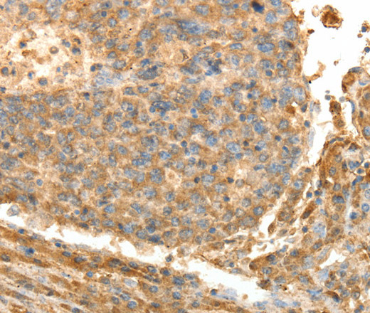 Immunohistochemistry of paraffin-embedded Human liver cancer using PSMD9 Polyclonal Antibody at dilution of 1:40