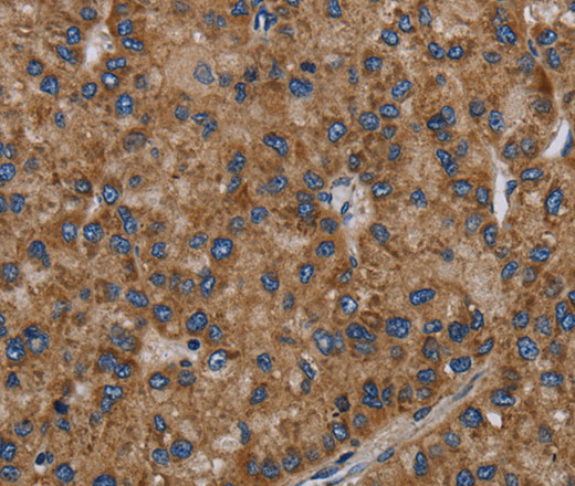 Immunohistochemistry of paraffin-embedded Human liver cancer tissue using NECTIN2 Polyclonal Antibody at dilution 1:40