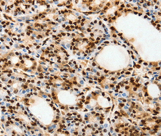 Immunohistochemistry of paraffin-embedded Human thyroid cancer using SPATA20 Polyclonal Antibody at dilution of 1:70