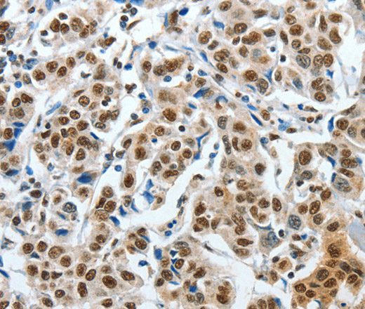 Immunohistochemistry of paraffin-embedded Human breast cancer tissue using CREB1 Polyclonal Antibody at dilution 1:30