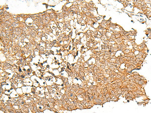 Immunohistochemistry of paraffin-embedded Human lung cancer tissue  using PRLHR Polyclonal Antibody at dilution of 1:70(?200)