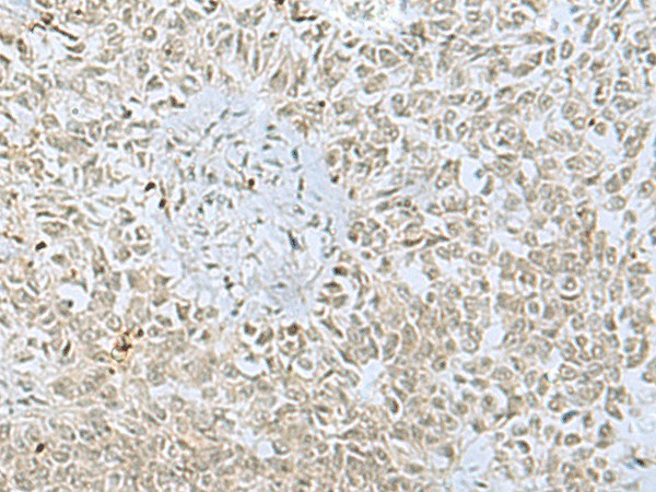 Immunohistochemistry of paraffin-embedded Human ovarian cancer tissue  using FOXQ1 Polyclonal Antibody at dilution of 1:30(?200)