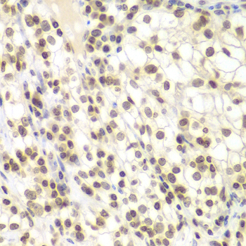 Immunohistochemistry of paraffin-embedded Human kidney cancer using UHRF2 Polyclonal Antibody at dilution of 1:200 (40x lens).