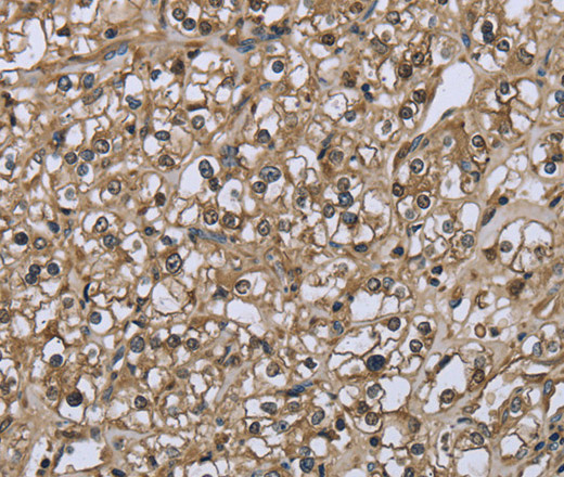 Immunohistochemistry of paraffin-embedded Human prostate cancer using FBP1 Polyclonal Antibody at dilution of 1:30