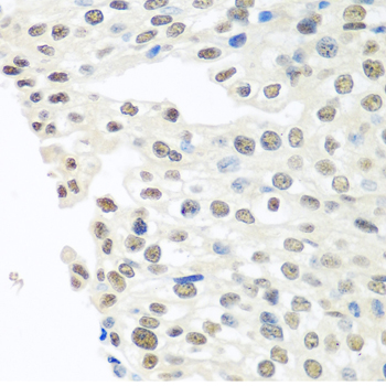 Immunohistochemistry of paraffin-embedded Human prostate cancer using TARDBP Polyclonal Antibody at dilution of  1:100 (40x lens).