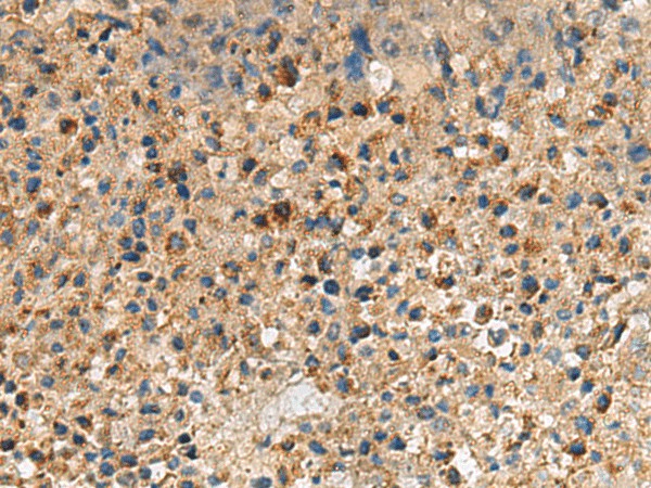 Immunohistochemistry of paraffin-embedded Human liver cancer tissue  using CXCR5 Polyclonal Antibody at dilution of 1:60(?200)