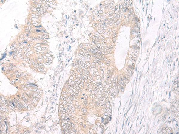 Immunohistochemistry of paraffin-embedded Human colorectal cancer tissue  using IL17A Polyclonal Antibody at dilution of 1:40(?200)