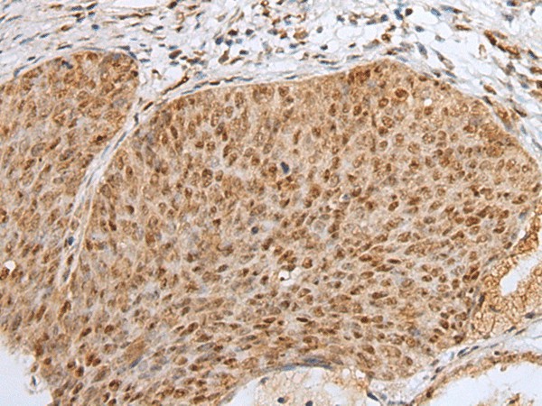 Immunohistochemistry of paraffin-embedded Human cervical cancer tissue  using ZNF354A Polyclonal Antibody at dilution of 1:40(?200)