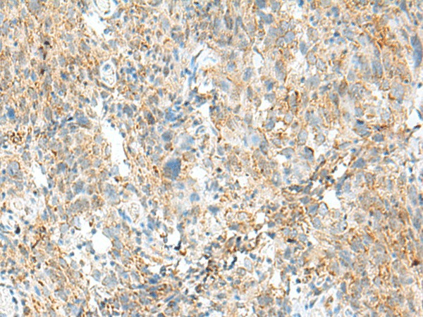 Immunohistochemistry of paraffin-embedded Human cervical cancer tissue  using MCCC1 Polyclonal Antibody at dilution of 1:45(?200)