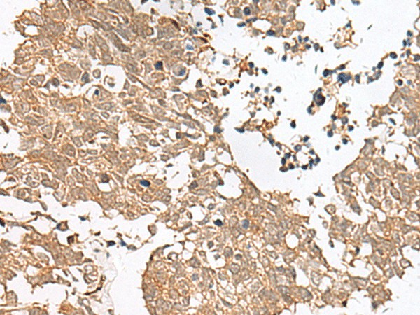 Immunohistochemistry of paraffin-embedded Human lung cancer tissue  using GRASP Polyclonal Antibody at dilution of 1:60(?200)