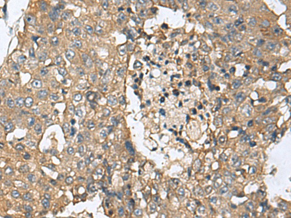 Immunohistochemistry of paraffin-embedded Human liver cancer tissue  using CD59 Polyclonal Antibody at dilution of 1:160(?200)