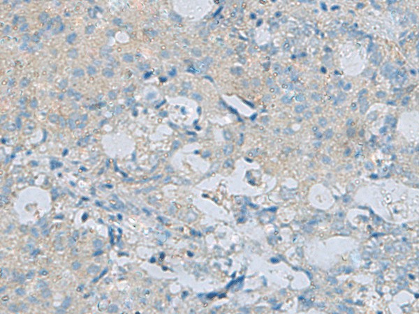 Immunohistochemistry of paraffin-embedded Human ovarian cancer tissue  using CDH12 Polyclonal Antibody at dilution of 1:60(?200)